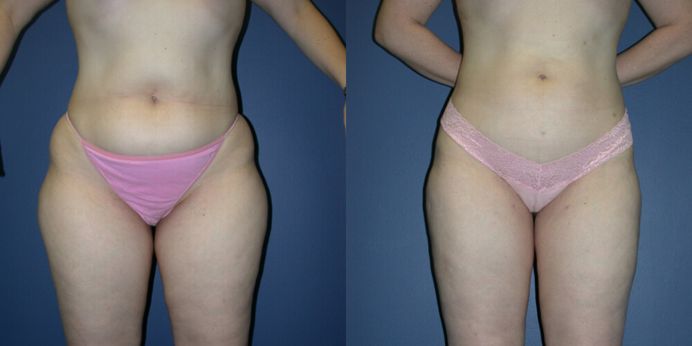 Liposuction vs. Tummy Tuck  Houston Liposuction Center